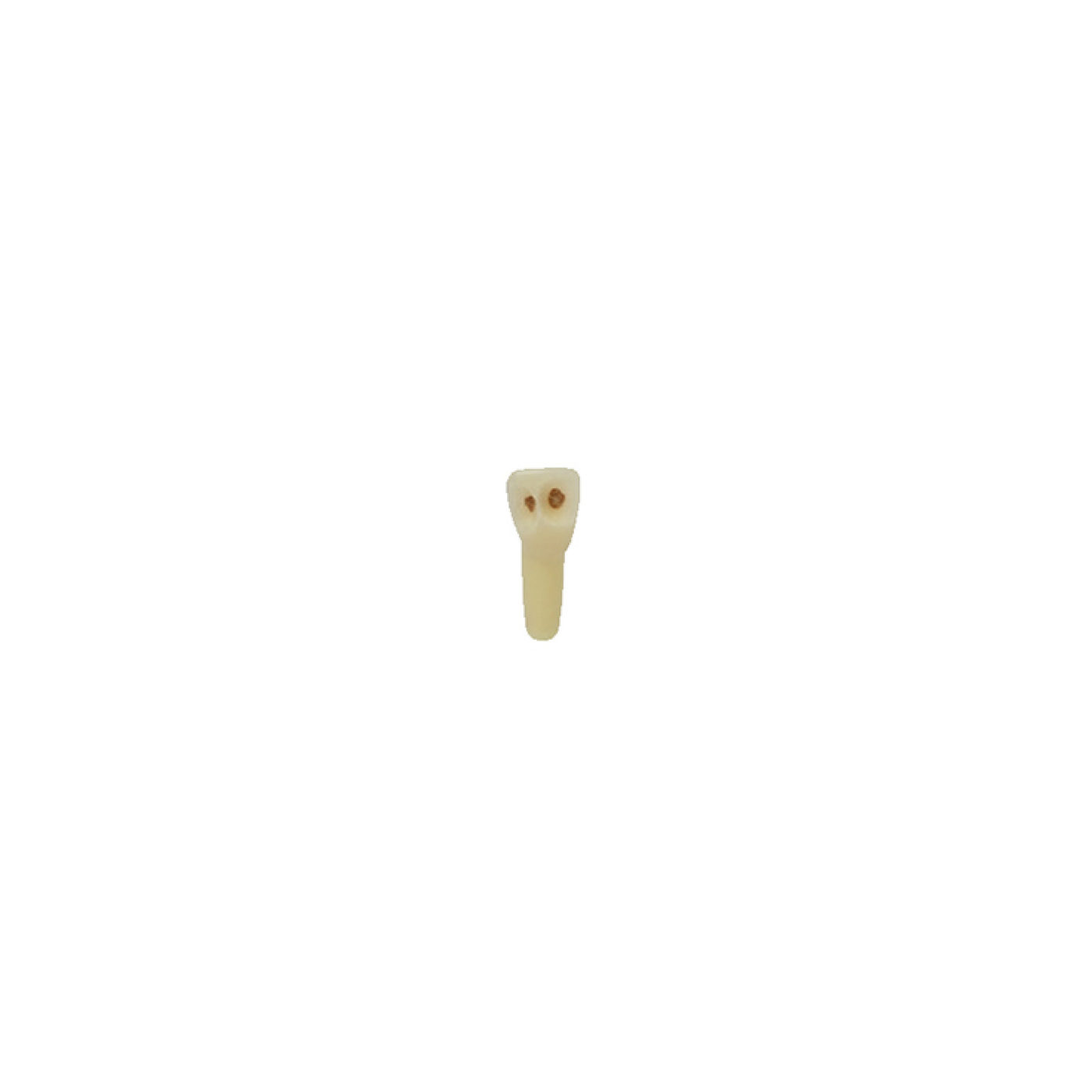 Diente Esmalte-Dentina Con Caries Nueva Version Para Tipodonto de 28 Dientes