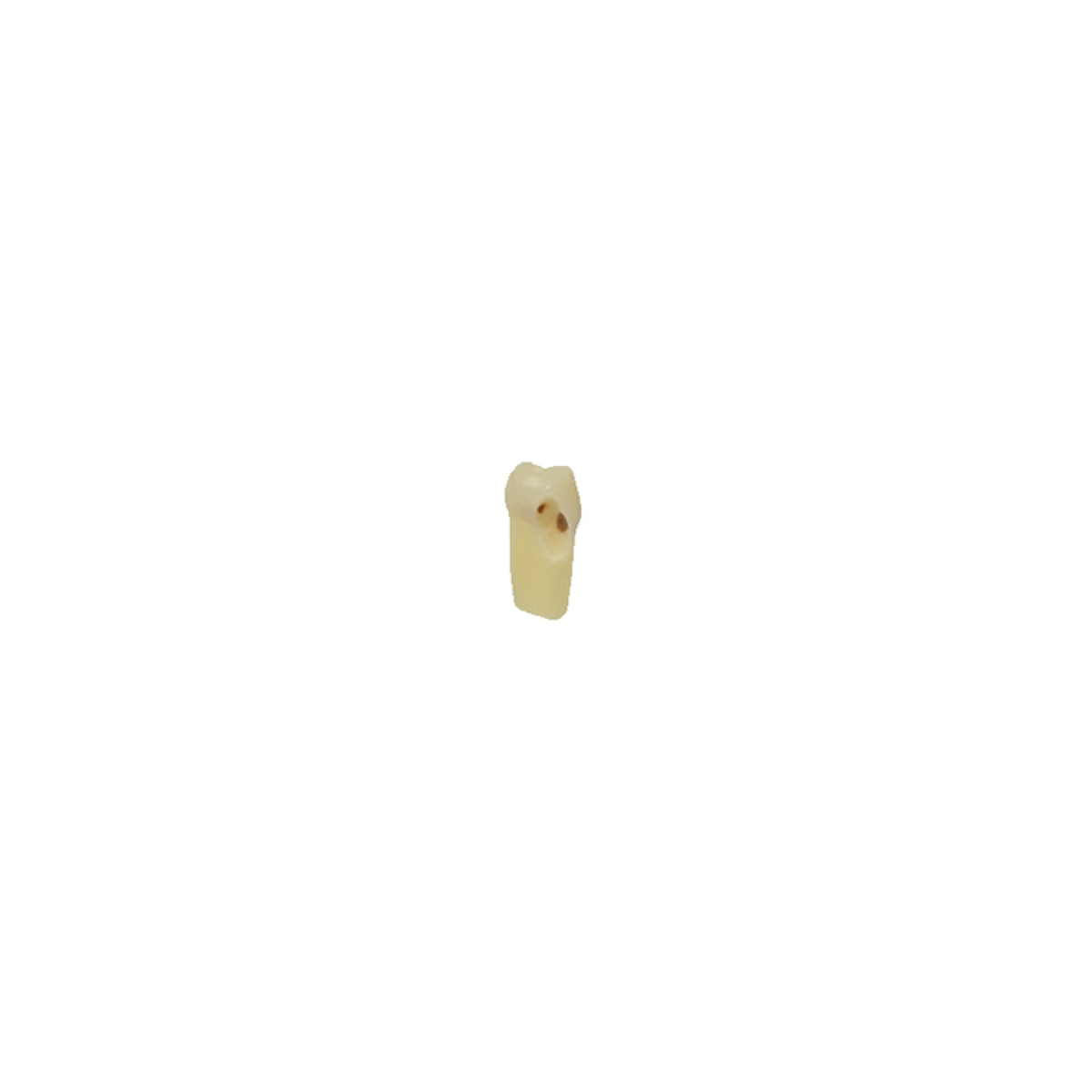 Diente Esmalte-Dentina Con Caries Nueva Version Para Tipodonto de 28 Dientes