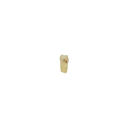 Diente Esmalte-Dentina Con Caries Nueva Version Para Tipodonto de 28 Dientes