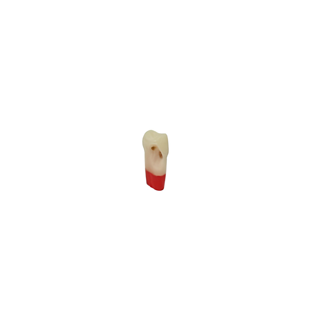 Diente Tres Capas Con Caries Nueva Version Para Tipodonto de 32 Dientes