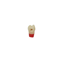 Diente Tres Capas Con Caries Nueva Version Para Tipodonto de 32 Dientes