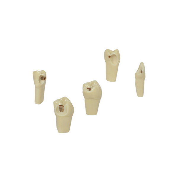 Diente Con Caries Socavada Reconocible En La Radiografía Dental - producto dental BIGtree
